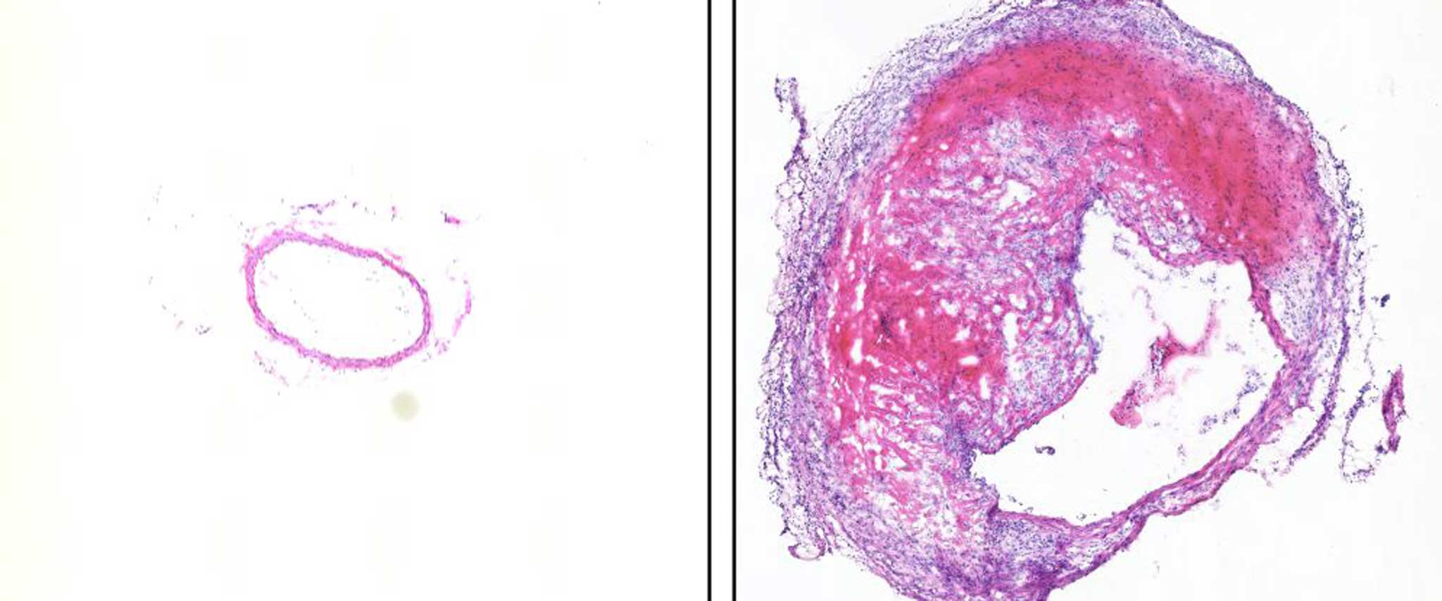 Warum Aortenaneurysmen am Gefäßbogen oder im Bauchabschnitt entstehen