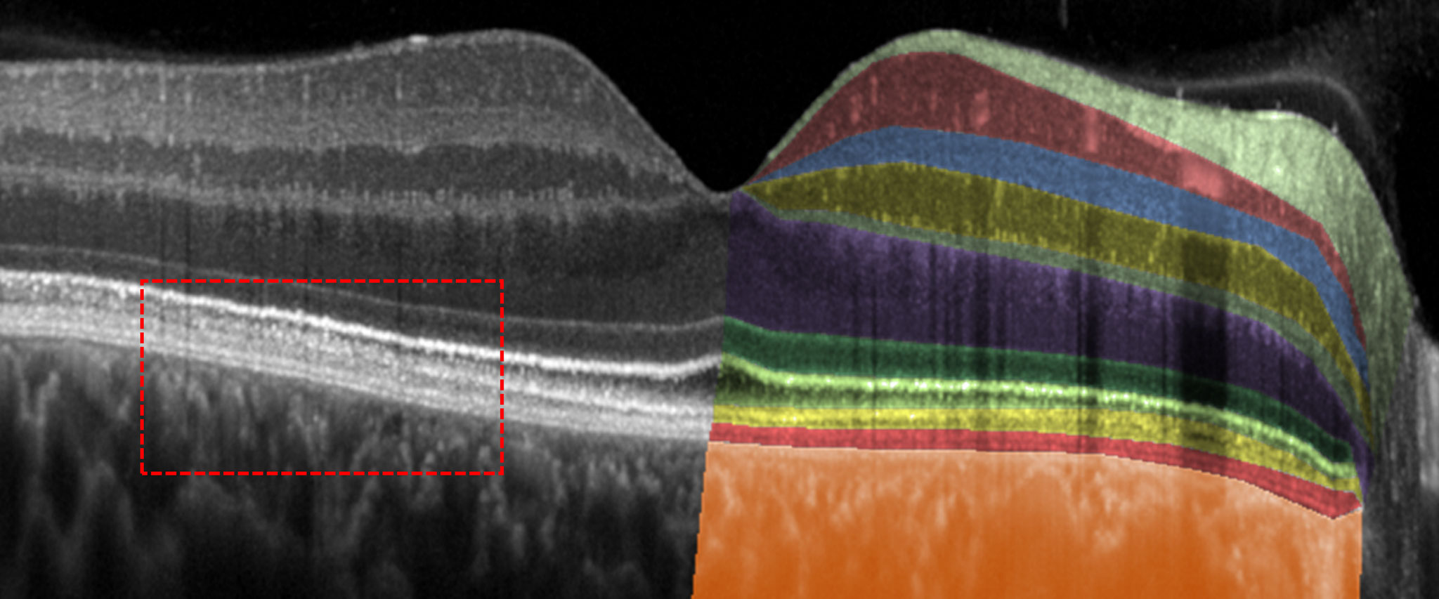 High-resolution OCT (high-res OCT) Schnitt durch die Fovea.