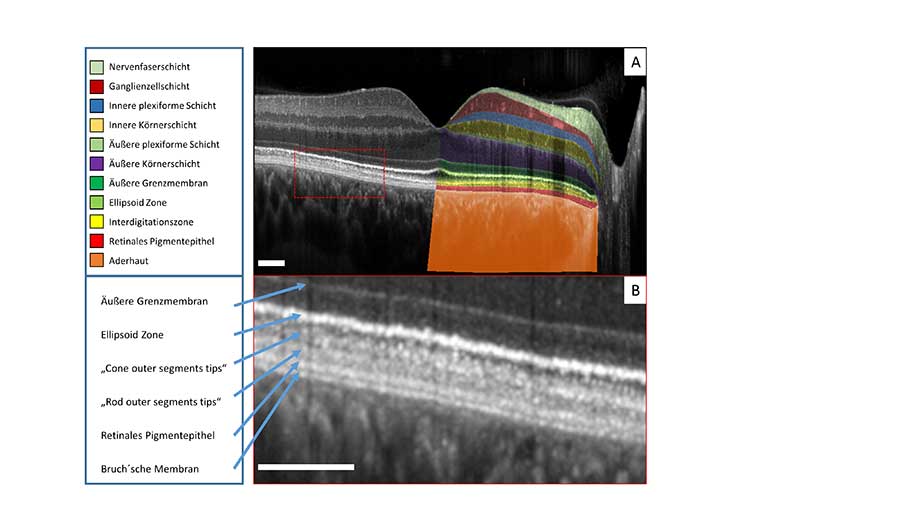 High-resolution OCT (high-res OCT) Schnitt durch die Fovea. 