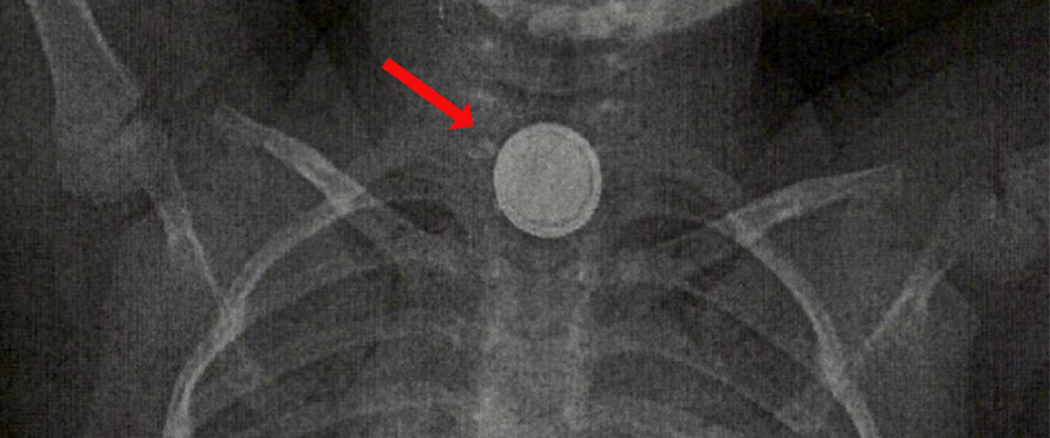 Röntgenbild: Knopfzellenbatterie (Pfeil) in der Speiseröhre eines Kleinkindes: Ein lebensbedrohlicher Notfall.