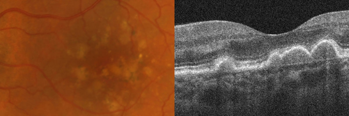 Abbildung 1: Farbfundusfotografie (links) und optische Kohärenztomographie (rechts) eines linken Auges mit Ablagerungen bei intermediärer AMD