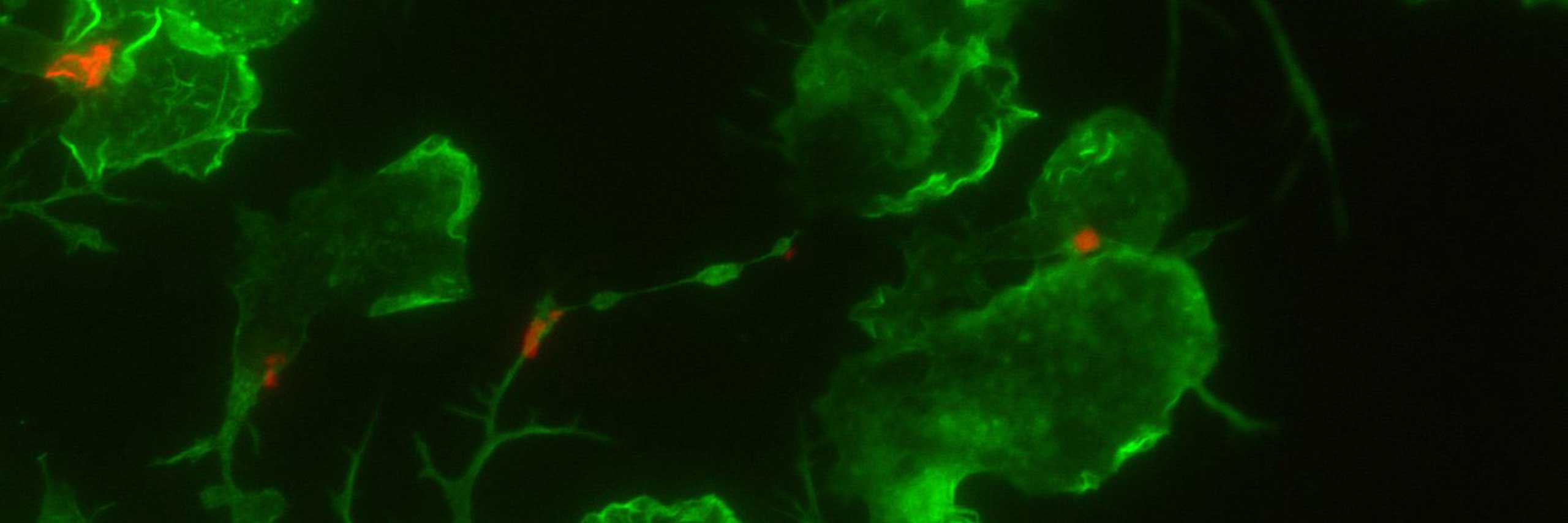 Gehirnzellen mit Ablagerungen von Amyloid-beta-Proteinen (rot), die charakteristisch für die Alzheimer-Krankheit sind.