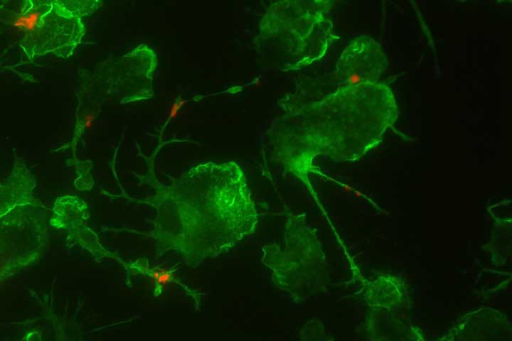 Gehirnzellen mit Ablagerungen von Amyloid-beta-Proteinen (rot), die charakteristisch für die Alzheimer-Krankheit sind.